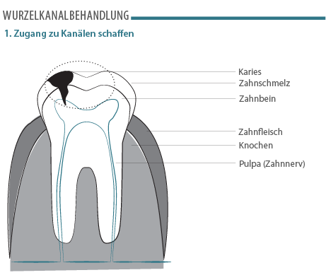 wurzelkanalbehandlung-schritt-1.png