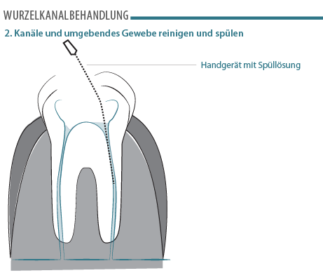 wurzelkanalbehandlung-schritt-2.png
