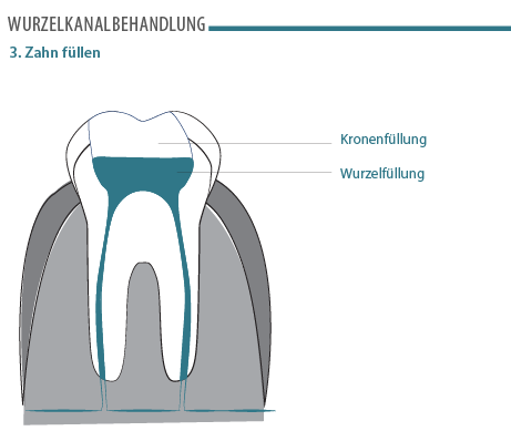 wurzelkanalbehandlung-schritt-3.png